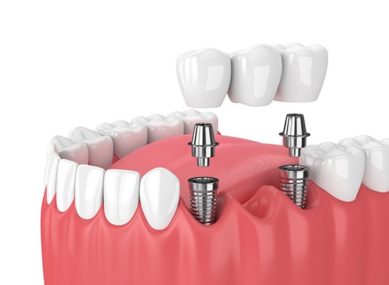 an illustration of implant dental bridges in Phoenix