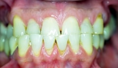 Yellowed and misaligned smile before cosmetic dentistry