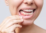 Woman pulling her lip down to reveal red, swollen gums