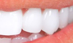 white teeth after