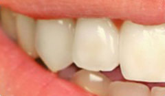 yellow teeth before