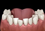 Illustration of crowded teeth