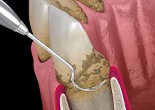 Side-view illustration of dental scaling process