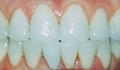 smile after restorations