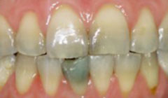 smile before restorations