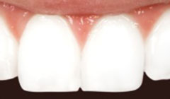 tooth bonded