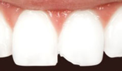 chipped tooth before