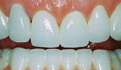 dental crowns after