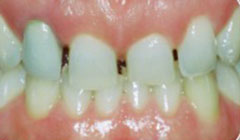 gaps before crowns