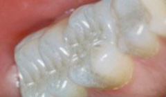 tooth colored fillings