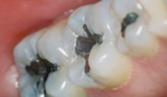 silver filling