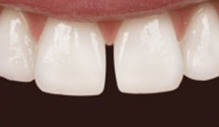 gap in teeth before