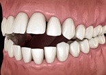 Illustration of an open bite