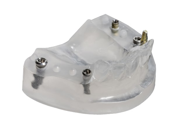 Model showing all on four dental implant position