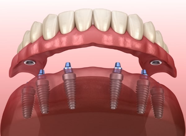 Animated smile during traditional dental implant denture placement