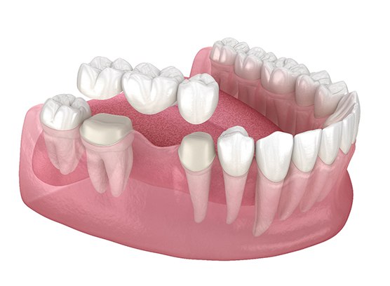 an illustration of traditional dental bridges in Phoenix