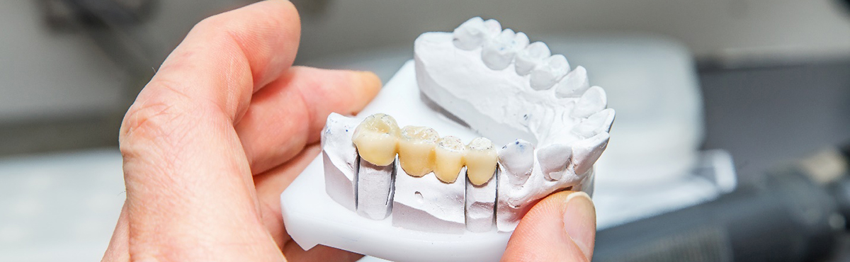 a person holding a model of dental bridges in Phoenix