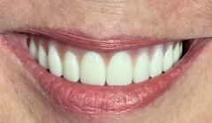Bright white smile after teeth whitening