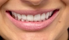 Bright white smile after teeth whitening