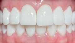 Bright white smile after teeth whitening