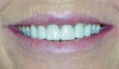 Bright white smile after teeth whitening