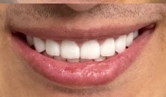 Bright white smile after teeth whitening