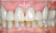 Bright white smile after teeth whitening