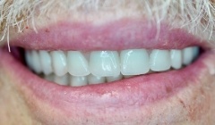 Bright white smile after teeth whitening
