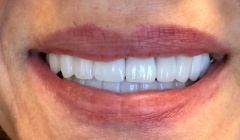 Bright white smile after teeth whitening