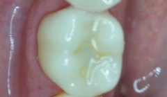 Bright white smile after teeth whitening