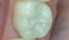Bright white smile after teeth whitening
