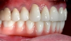 Side view of smile after missing bottom teeth are replaced