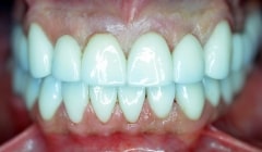 Flawless bright white smile after cosmetic dentistry