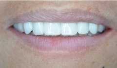 Smile after missing top teeth were replaced