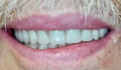 Healthy beautiful smile after dental dcay and damage is repaired