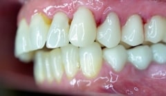 Side view of smile with healthy teeth and gums