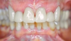 Healthy flawless smile after restorative dentistry