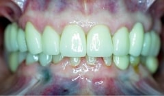Bright white smile after teeth whitening
