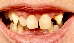 Severely discolored smile before teeth whitening