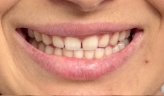 Severely discolored smile before teeth whitening