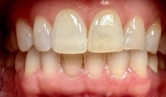 Severely discolored smile before teeth whitening
