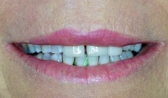 Severely discolored smile before teeth whitening