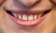 Severely discolored smile before teeth whitening