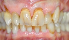 Severely discolored smile before teeth whitening