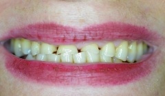 Severely discolored smile before teeth whitening