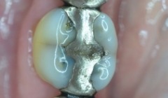 Severely discolored smile before teeth whitening