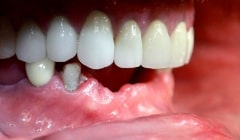 Side view of smile with missing bottom teeth