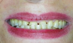 Yellowe and unevenly spaced teeth before cosmetic dentistry
