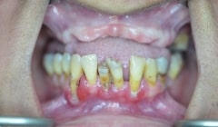 Smile with missing top teeth
