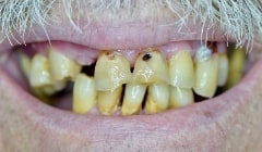 Severely decayed and damged smile